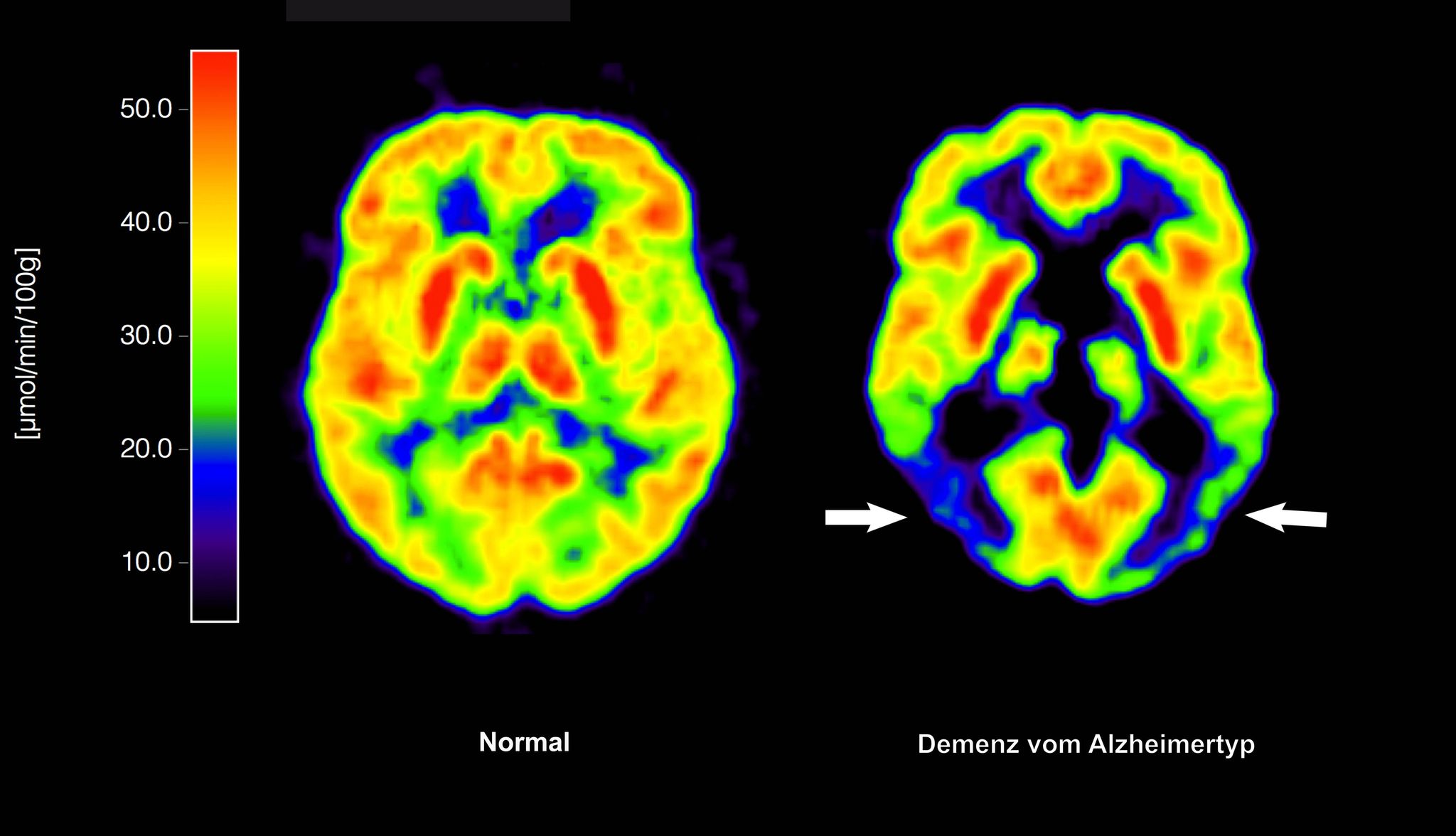 Haben die Amyloid-Plaques schon irreversible Schäden im Gehirn angerichtet, nützt ihre Entfernung nichts mehr. (Archivbild)