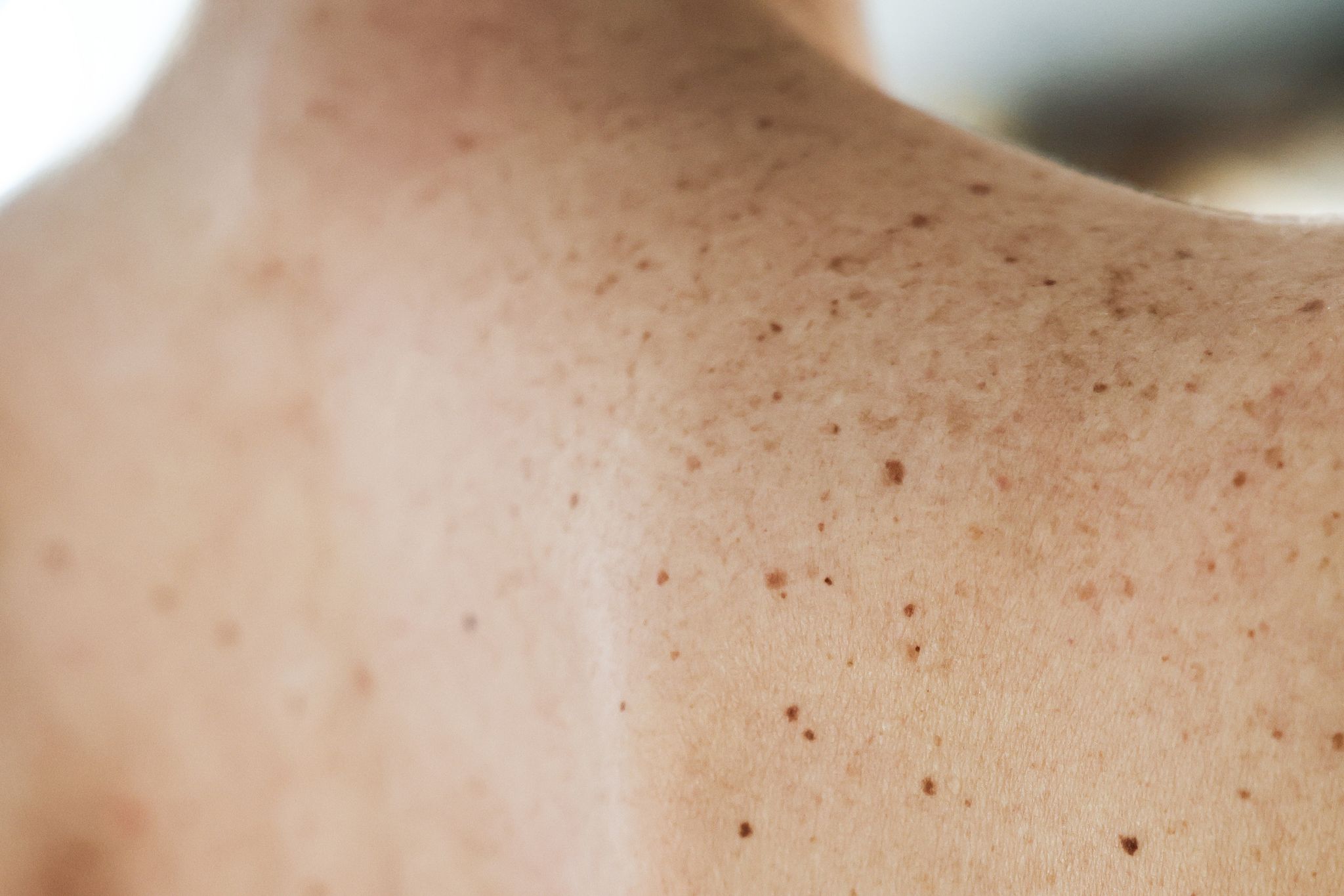 Hautkrebs ist einer der häufigsten Krebserkrankungen in Deutschland.